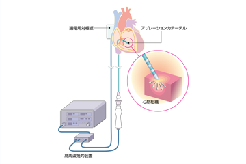 カテーテルアブレーションイメージ